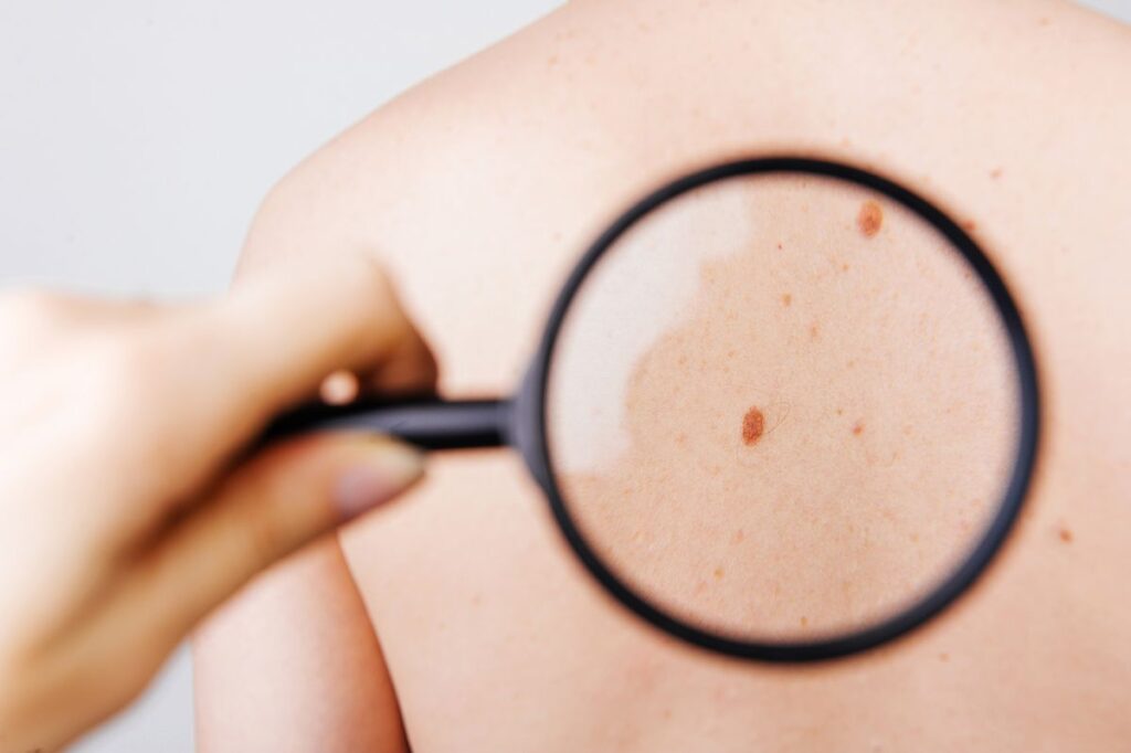 Doctor examining a suspicious skin lesion for early signs of skin cancer.