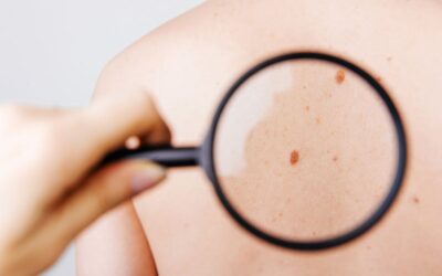 Doctor examining a suspicious skin lesion for early signs of skin cancer.