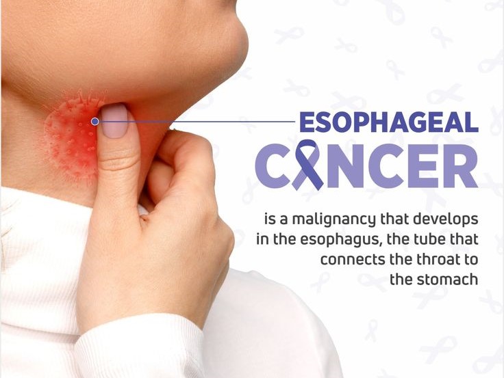 Early warning signs of esophageal cancer explained by cancer specialist